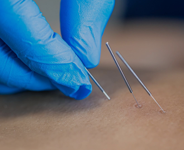 Dry Needling Noblesville, IN
