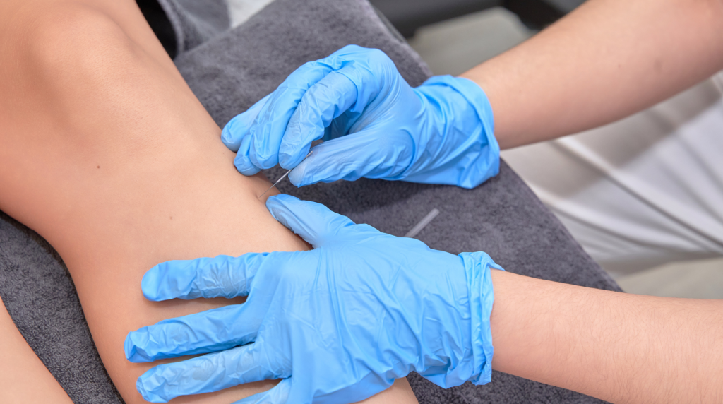 dry needling
