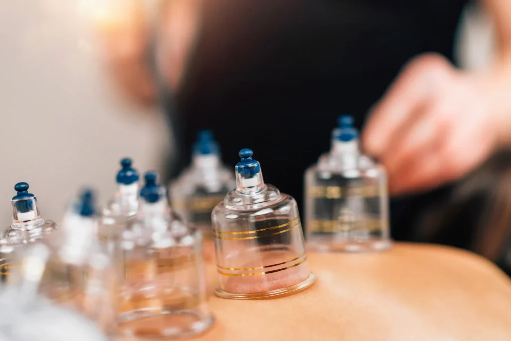 Cupping