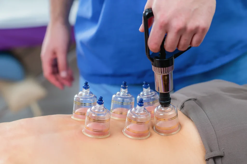 Cupping Therapy Explained for Active Adults and Athletes