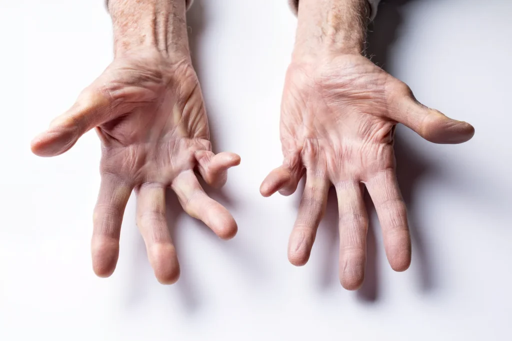 Staying Active With Ehlers-Danlos Syndrome